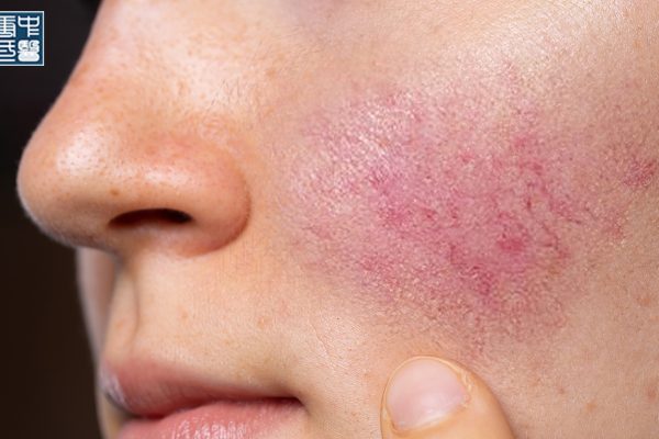 What Is Dampness Heat in TCM and How Does It Affect Your Skin Health?