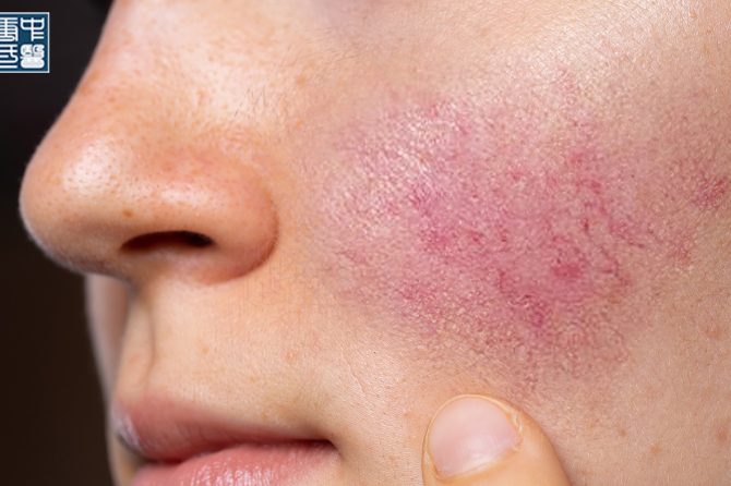 What Is Dampness Heat in TCM and How Does It Affect Your Skin Health?