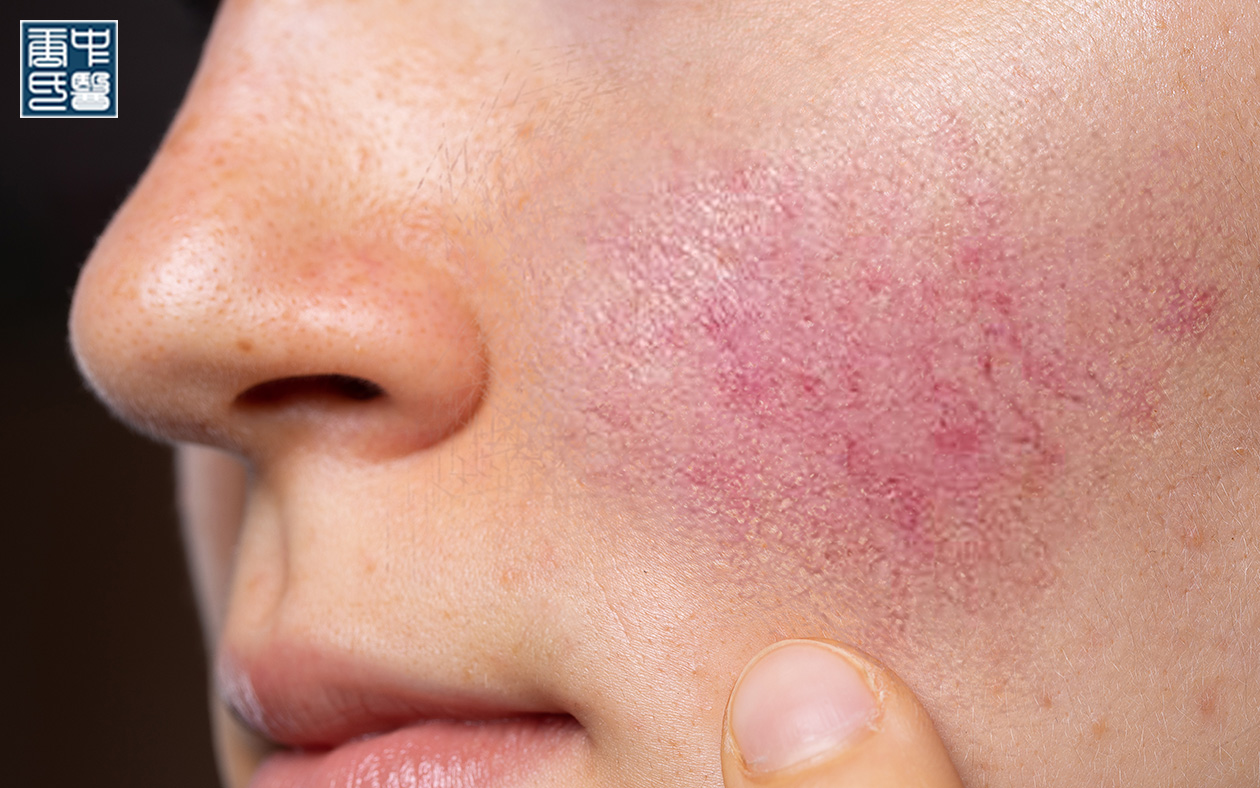 What Is Dampness Heat in TCM and How Does It Affect Your Skin Health?