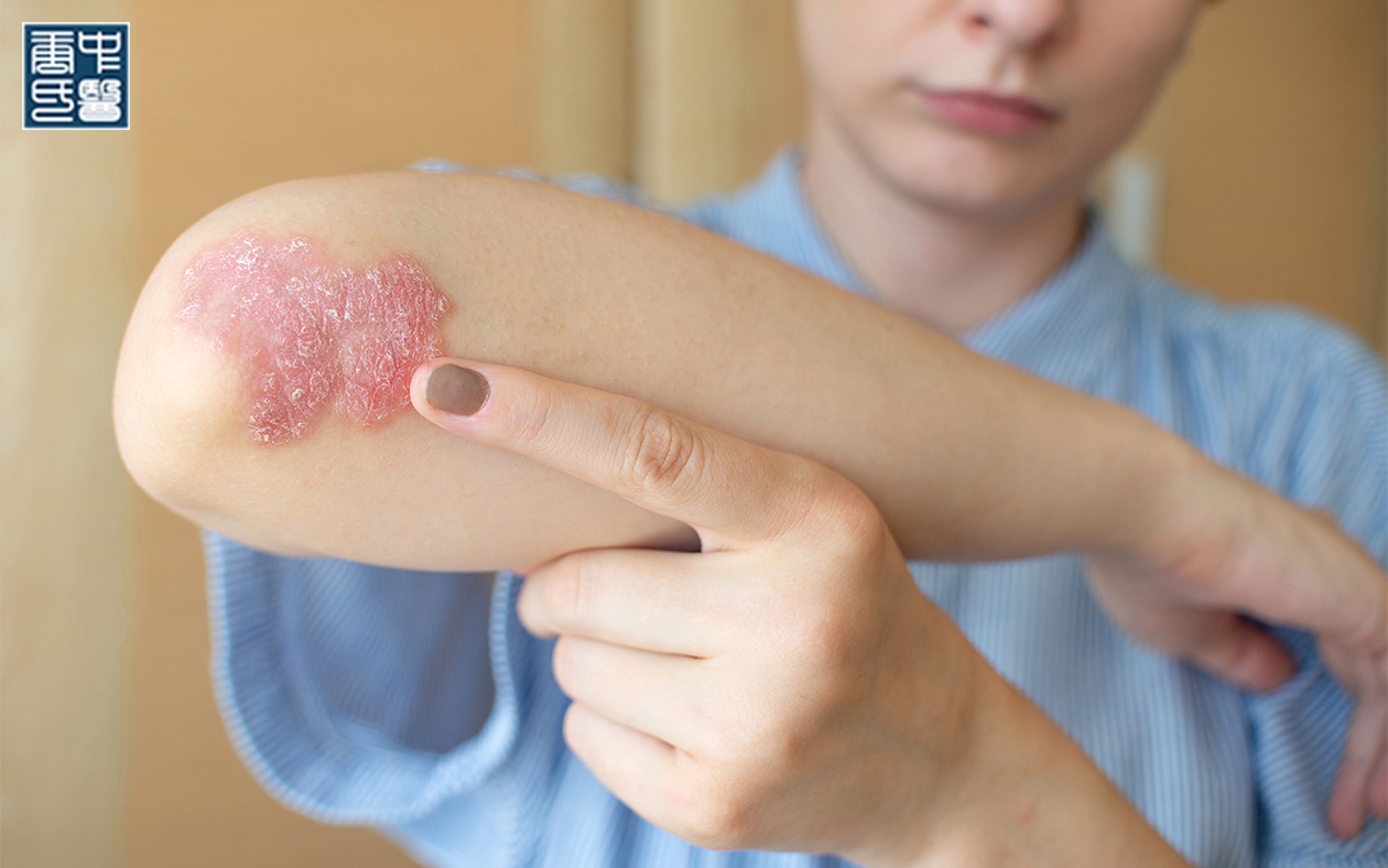 Close-up of a psoriasis patch on the arm, treated with TCM.
