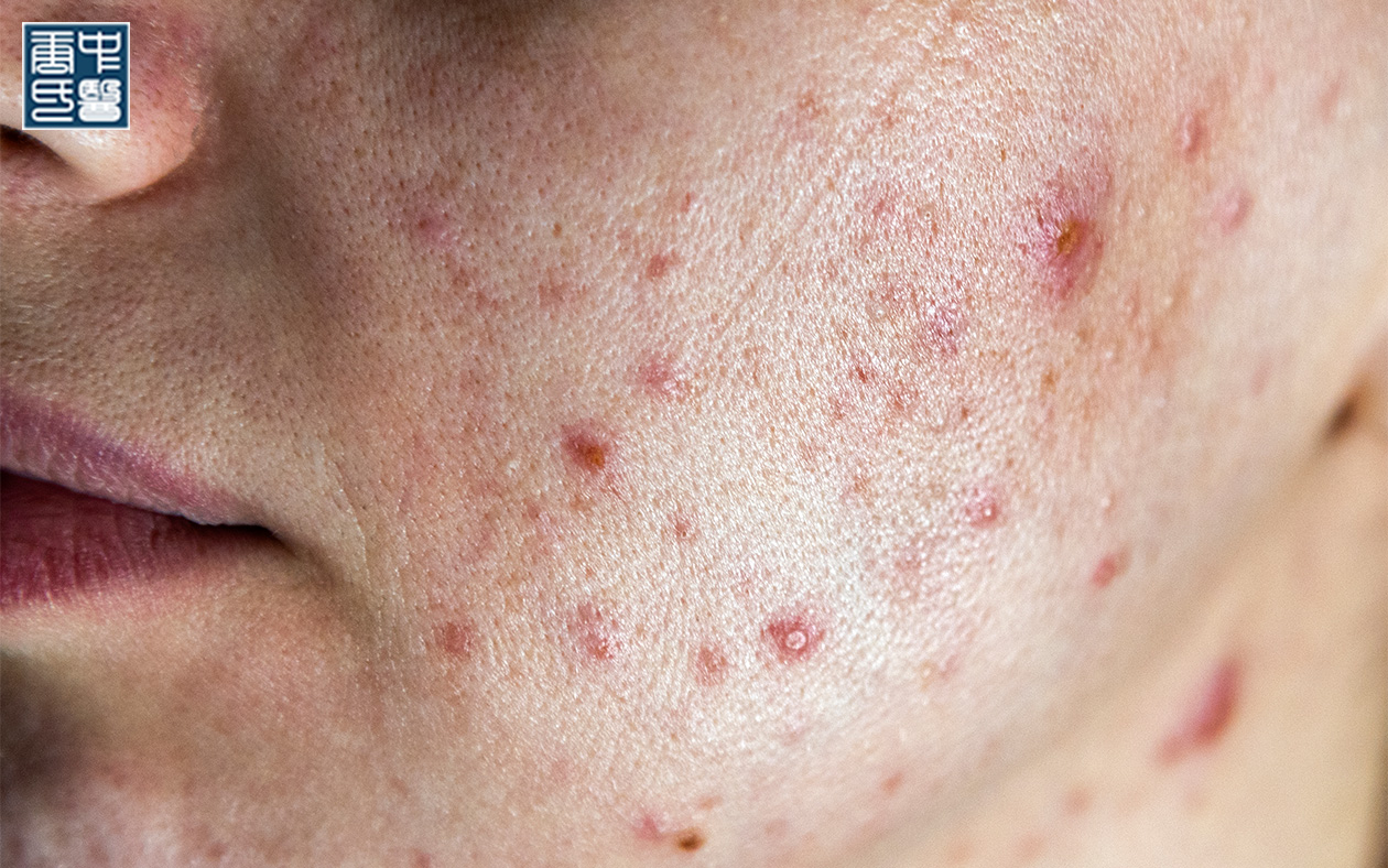 Close-up of inflamed acne, a skin condition related to TCM immunity.