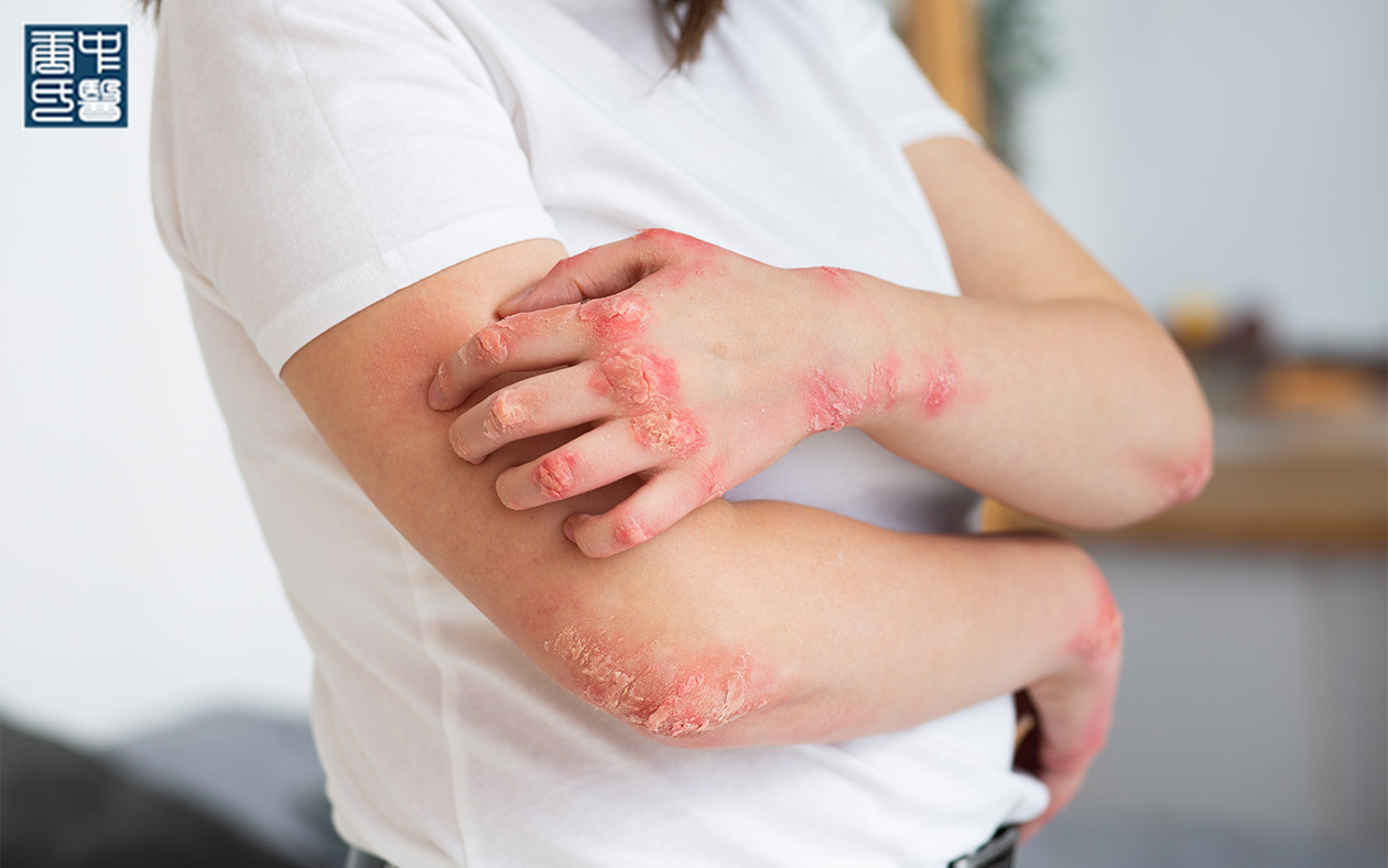 Person showing severe skin flare-up on arm due to immune imbalance.