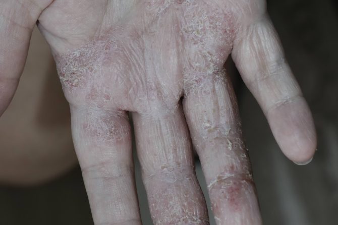 Individualized Traditional Chinese Medicine in the Management of Steroid-Dependent Chronic Palmar Eczema: A Case Report