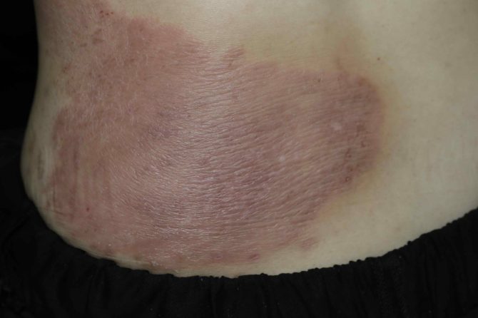 Systemic Regulation and Homeostatic Reconstruction in Chronic Atopic Dermatitis: A 70-Month Clinical Follow-up Analysis of a Patient with a 37-Year Medical History 慢性特应性皮炎的系统性调节与稳态重建：一例37年病史患者的70个月临床随访分析