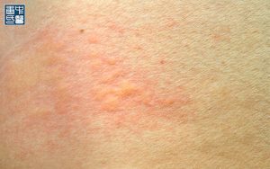 Close-up of human skin showing a red, raised urticaria (hives) rash.