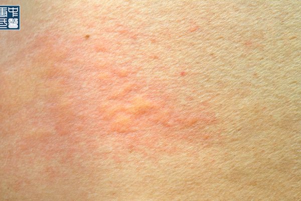 Understanding Two Different Types of Hives From a TCM Perspective: Acute vs Chronic