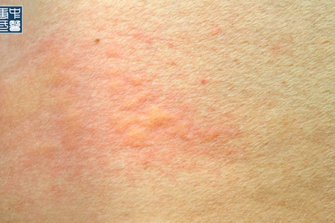 Understanding Two Different Types of Hives From a TCM Perspective: Acute vs Chronic