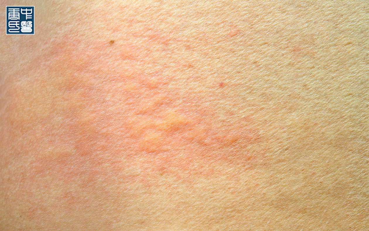 Close-up of human skin showing a red, raised urticaria (hives) rash.