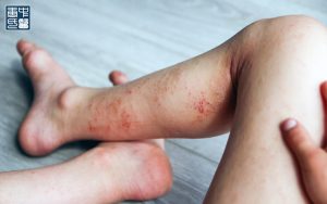 Child's leg showing inflamed eczema rash.