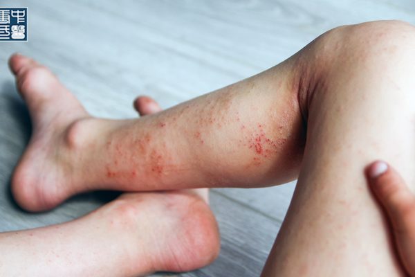 How to Stop Eczema Itching at Night : A TCM-Inspired Approach