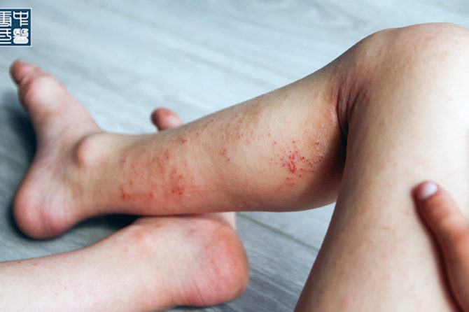 How to Stop Eczema Itching at Night : A TCM-Inspired Approach