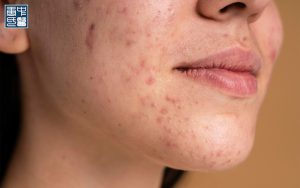 Close-up of a person's chin and mouth with acne and blemishes.