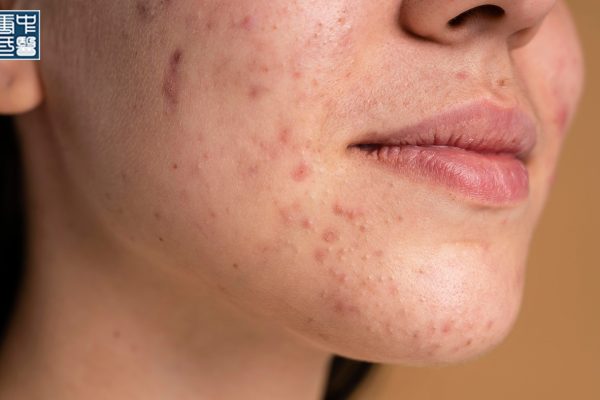 What Is TCM Detox and How It Improves Skin Clarity and Reduces Acne