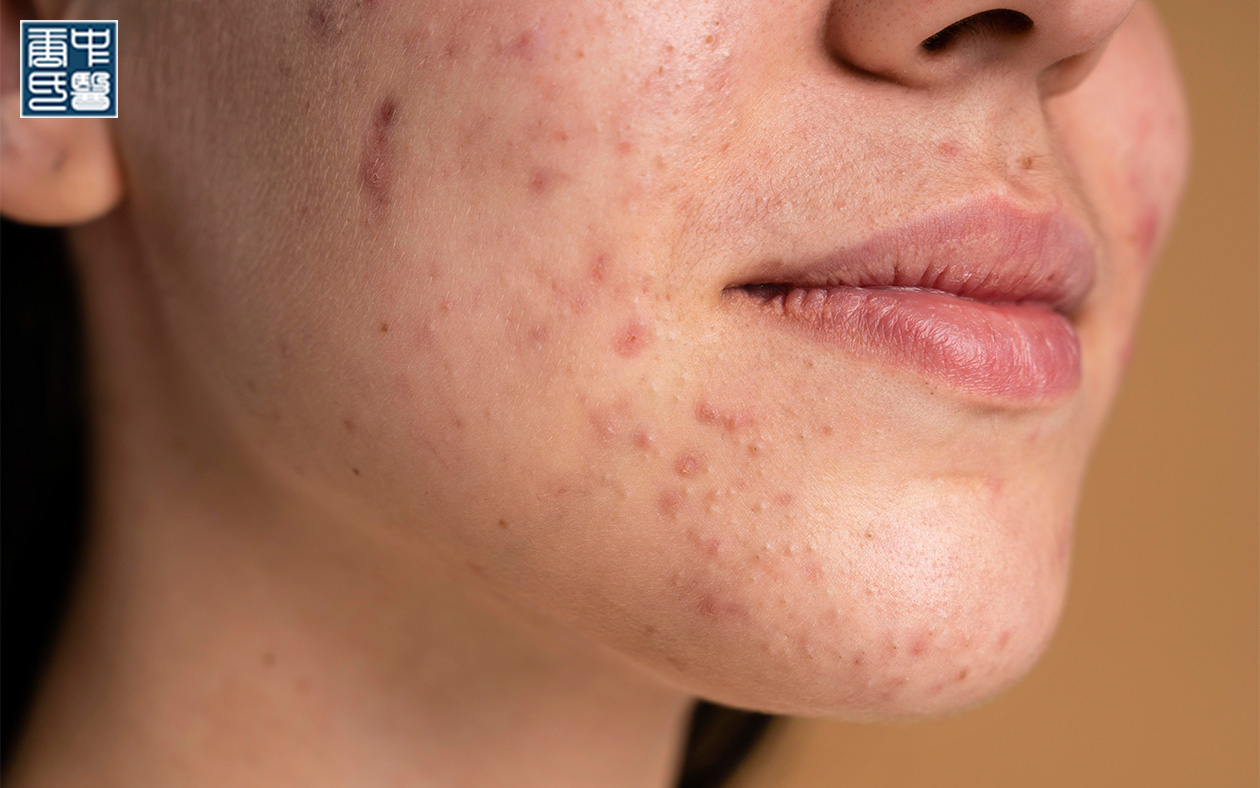 Close-up of a person's chin and mouth with acne and blemishes.