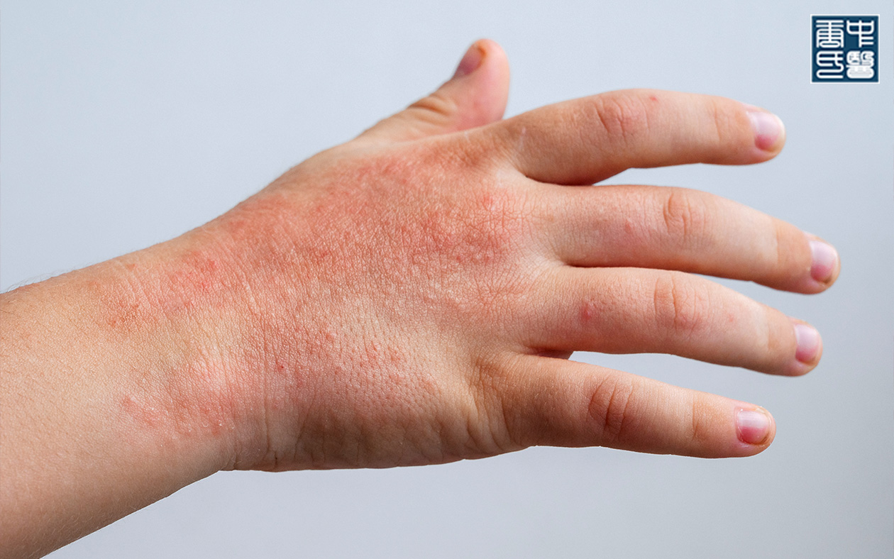 Hand with inflamed eczema rash due to poor healing.