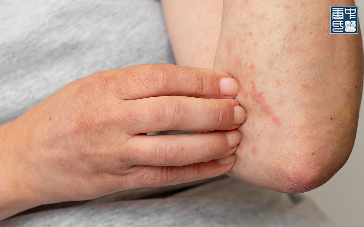 Dry, itching eczema on the elbow.