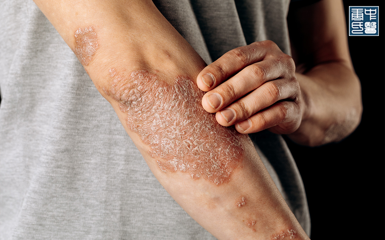 Psoriasis flare-up on the arm.