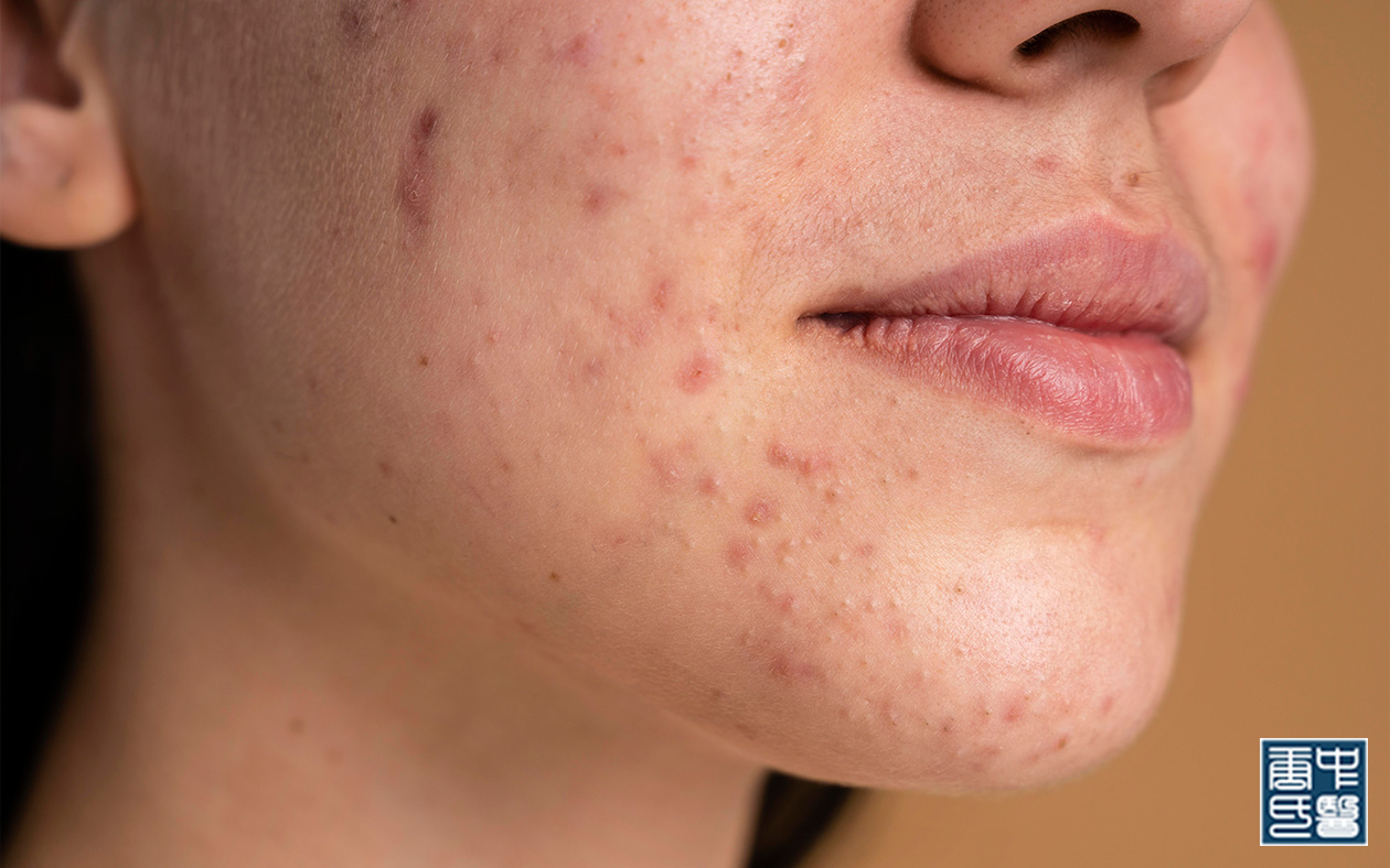 Skin with acne and poor healing.