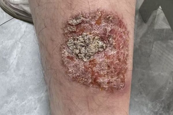From Suppression to Restoration: A TCM Case Perspective on 14-Month Recovery in Chronic Eczema 从压制到修复：一例慢性湿疹14个月恢复过程中的中医逻辑