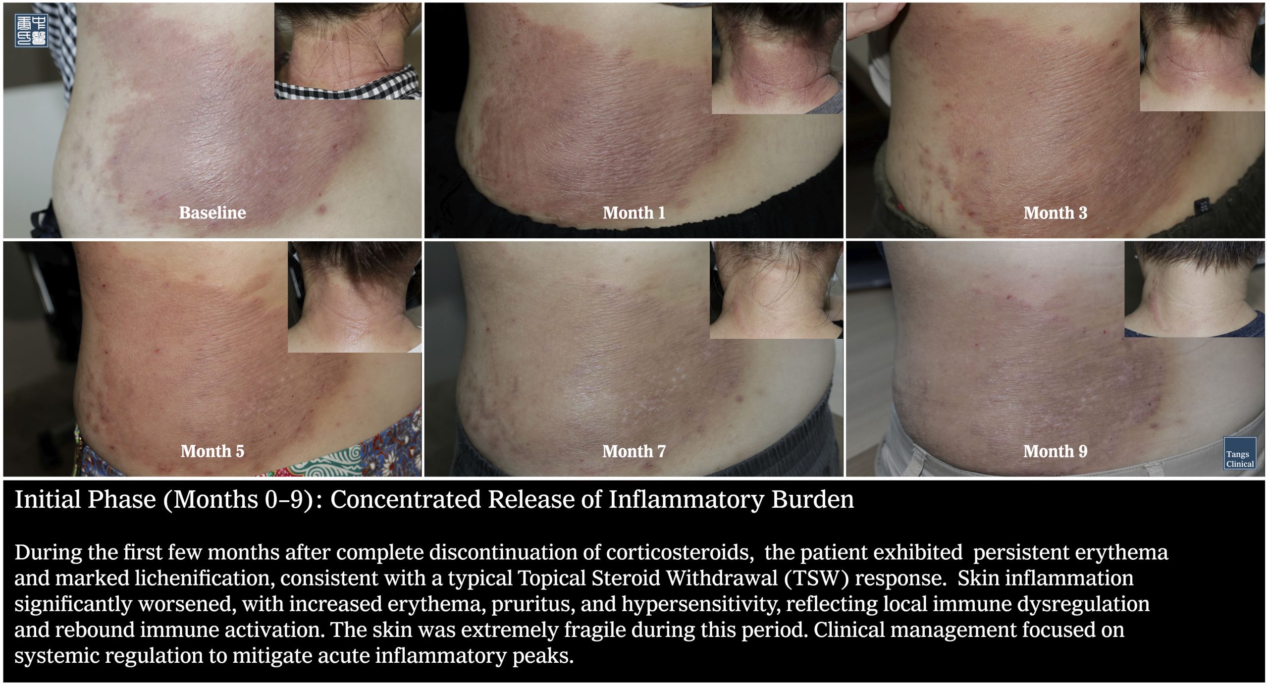 Baseline-Month 9: Clinical remission of chronic atopic dermatitis after 37 years of steroid use - Tangs Clinical