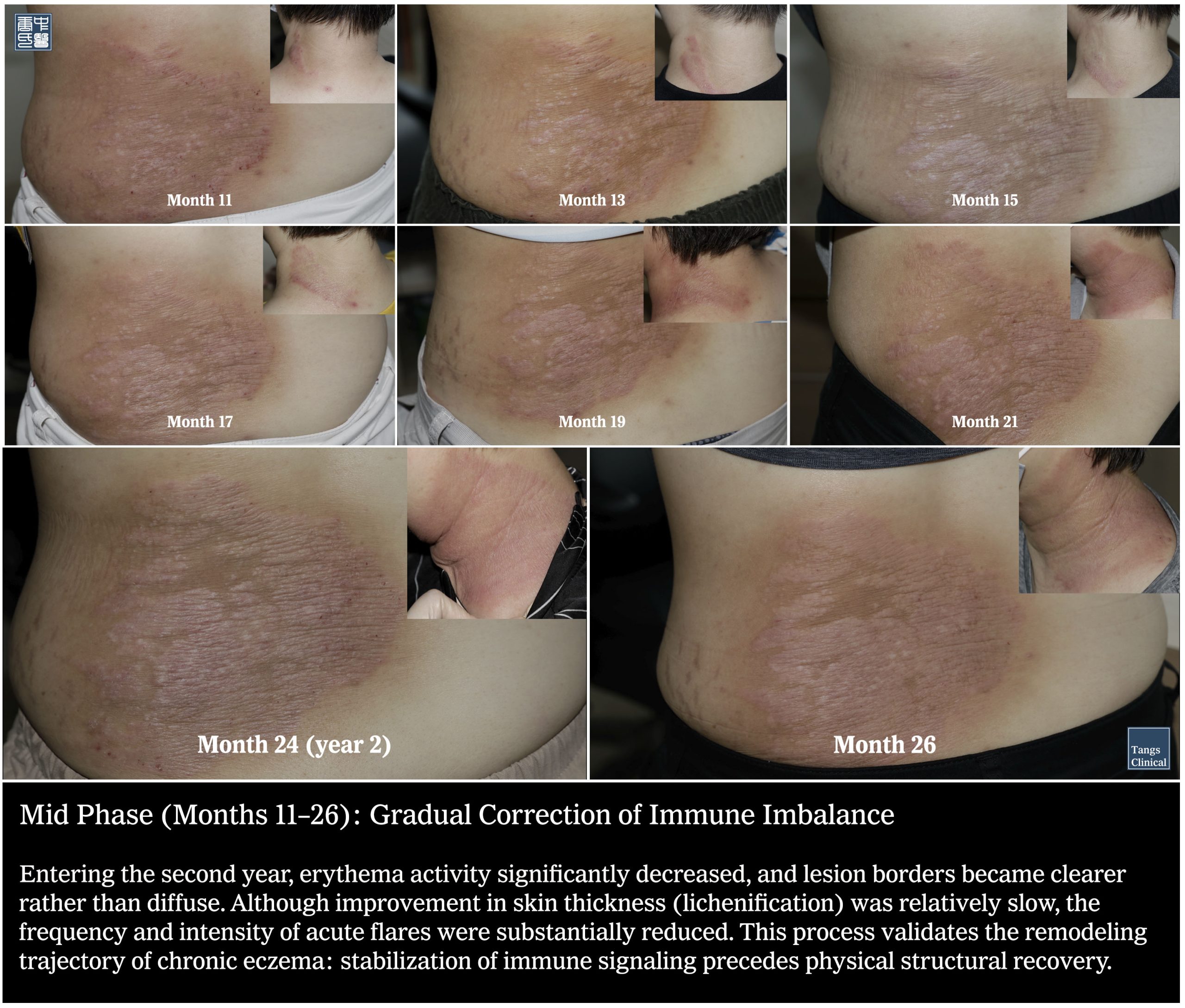Month 11-26: Clinical remission of chronic atopic dermatitis after 37 years of steroid use - Tangs Clinical