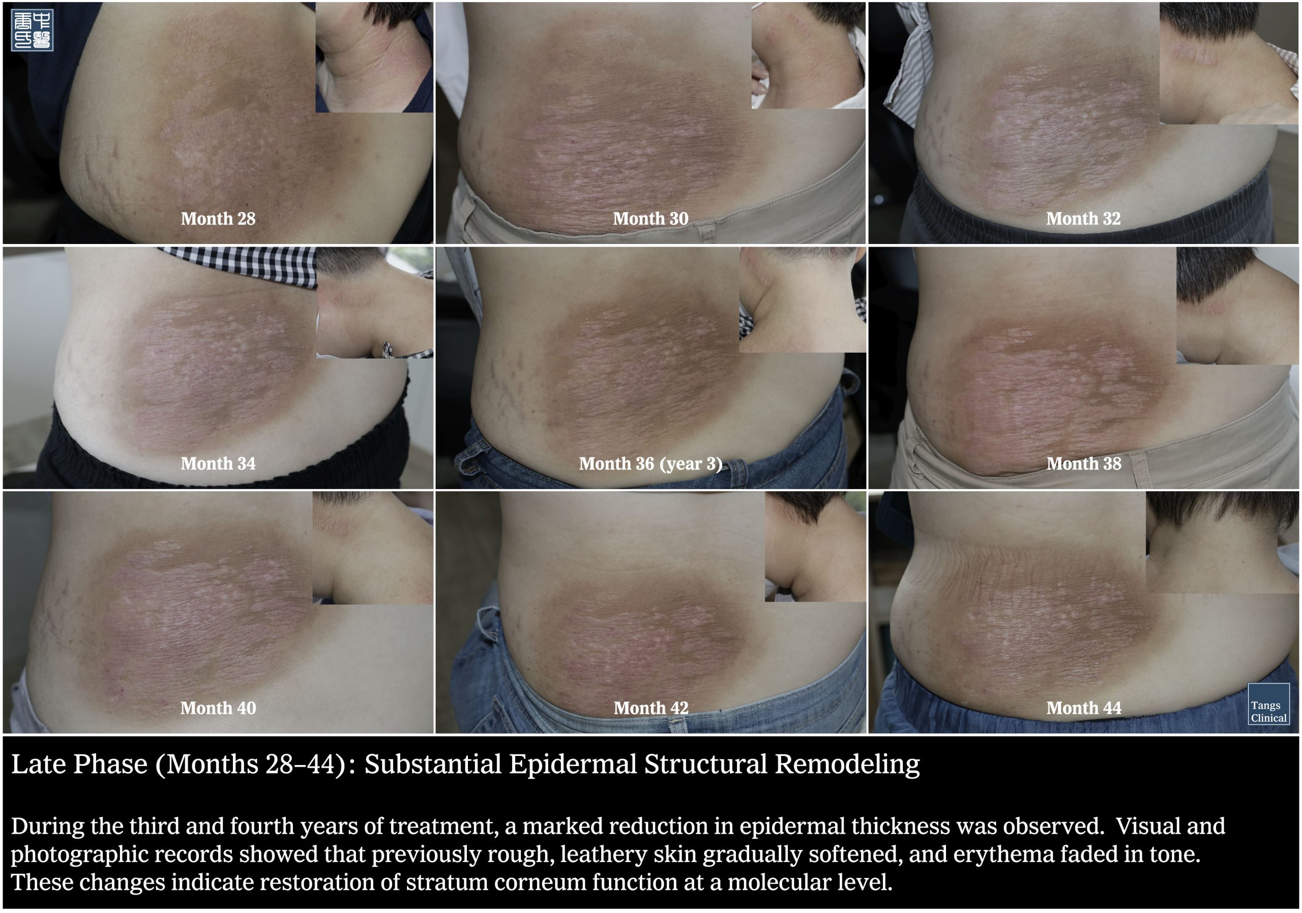 Month 28-44: Clinical remission of chronic atopic dermatitis after 37 years of steroid use - Tangs Clinical