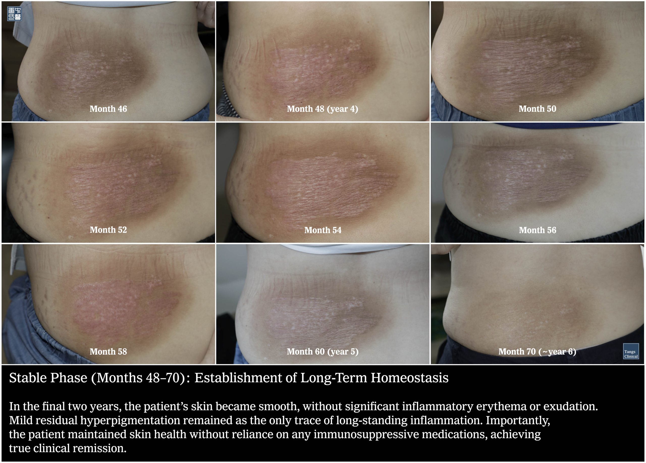 Month 48: Clinical remission of chronic atopic dermatitis after 37 years of steroid use - Tangs Clinical