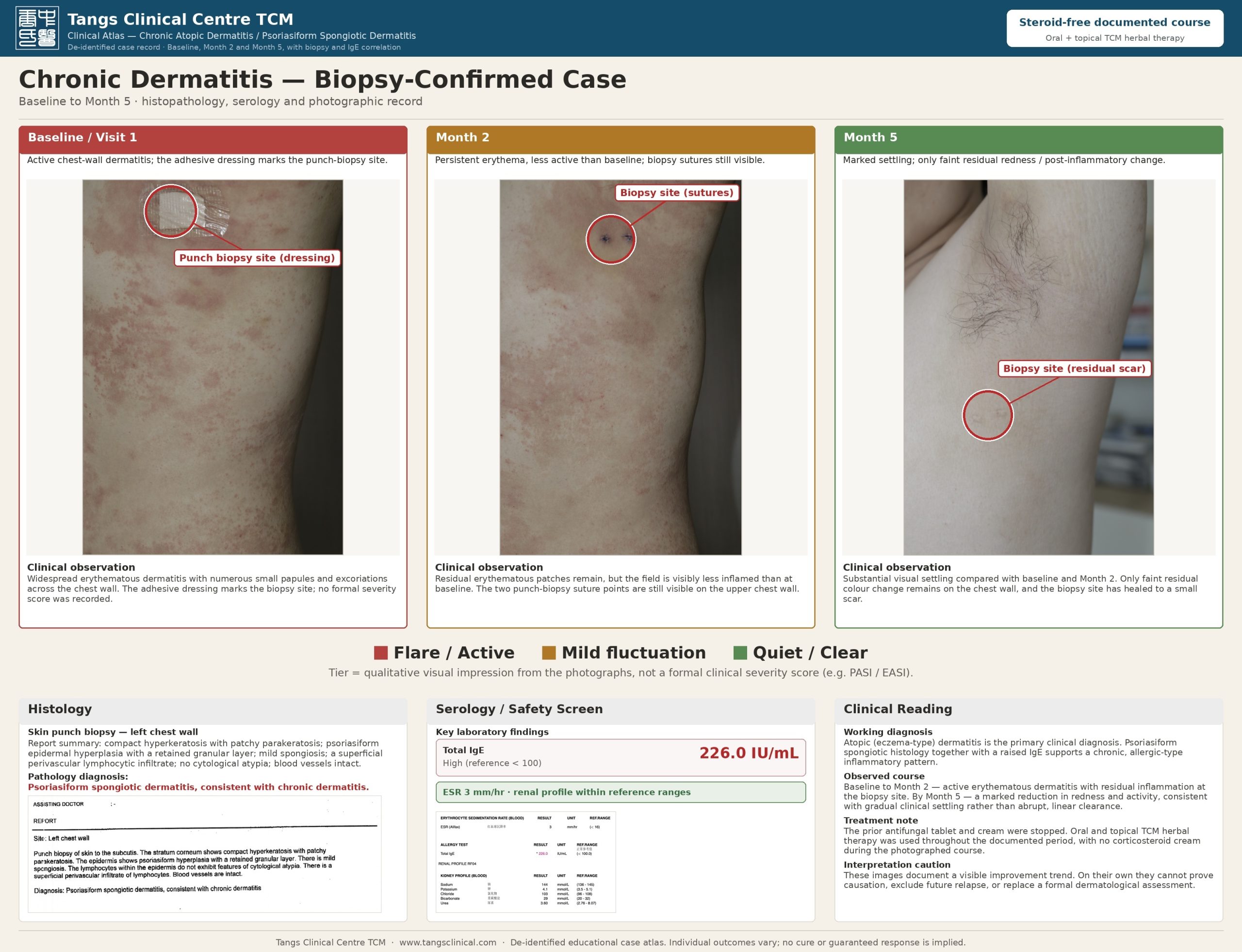 Baseline to Month 5 clinical atlas showing biopsy-site localisation, histology, serum IgE, and photographic progression. The biopsy was taken from the left chest wall at baseline. This atlas documents the chest-wall biopsy region over the first five months; the neck region is documented separately over the full 20 months in Figure 2 (same patient). Image interpretation remains observational and should not replace formal dermatological assessment.