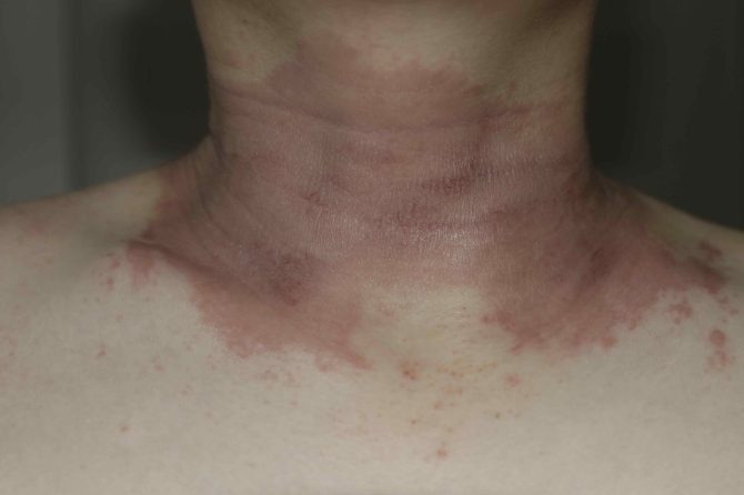 Chronic Atopic Dermatitis With Psoriasiform Spongiotic Features: A 20-Month Steroid-Free Clinical Course Under TCM Herbal Therapy